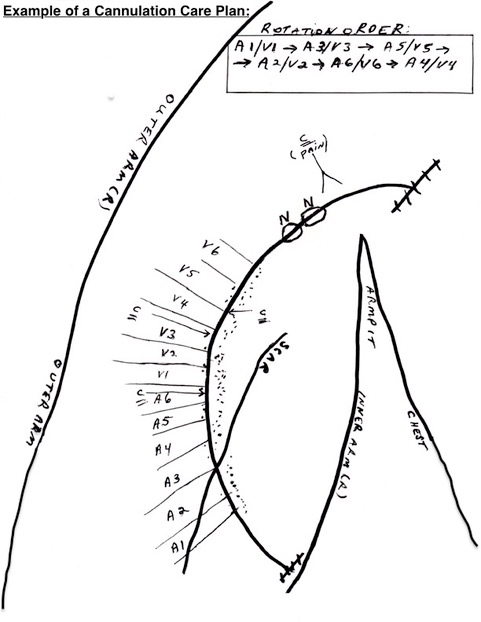 Cannulation care plan sketch with rotation order.